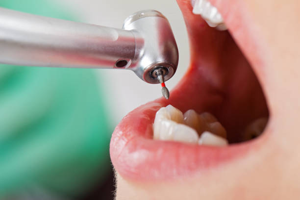 Best Emergency Tooth Extraction in Dentsville, SC
